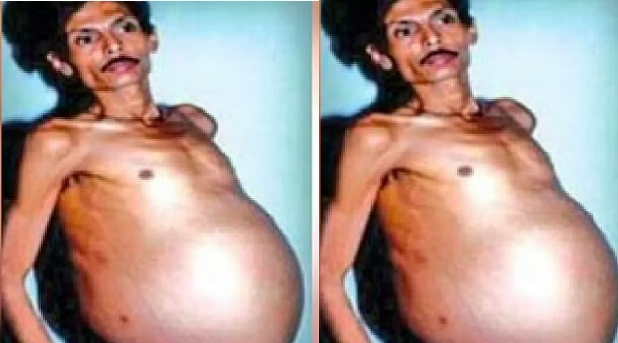 36 साल से प्रेग्नेंट था आदमी (Pregnant Man)! ऑपरेशन करने पर निकला कुछ ऐसा, दंग रह गए डॉक्टर